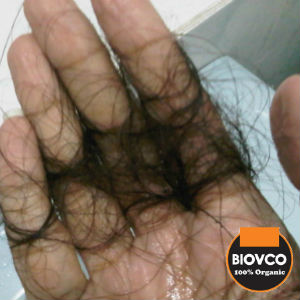 Kekurangan Nutrisi Punca Rambut Gugur, rawatan rambut gugur dengan minyak kelapa BioVCO