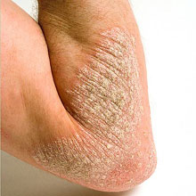 Psoriasis Kulit merekah, bersisik