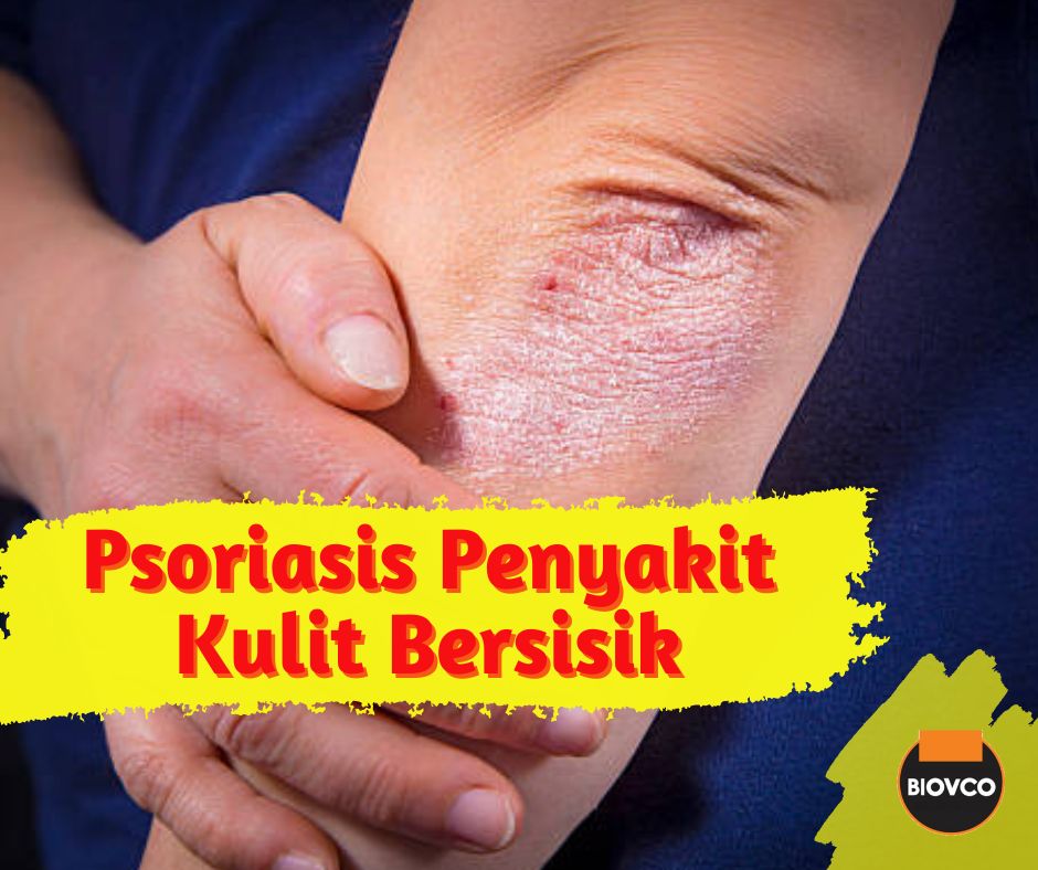 Psoriasis ialah sejenis penyakit autoimun kronik, yang menjejaskan kulit. Psoriasis berlaku apabila sistem imun