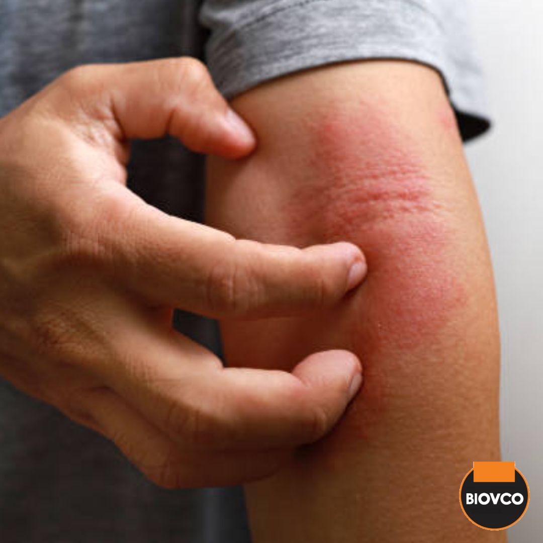 Jangan biarkan psoriasis mengawal hidup anda.